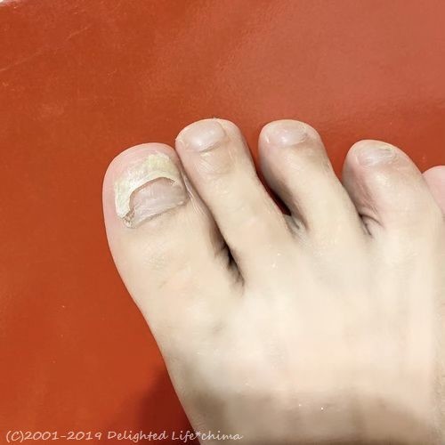 ポロリと剥がれた二重爪 Delighted Life クックパッドブログ